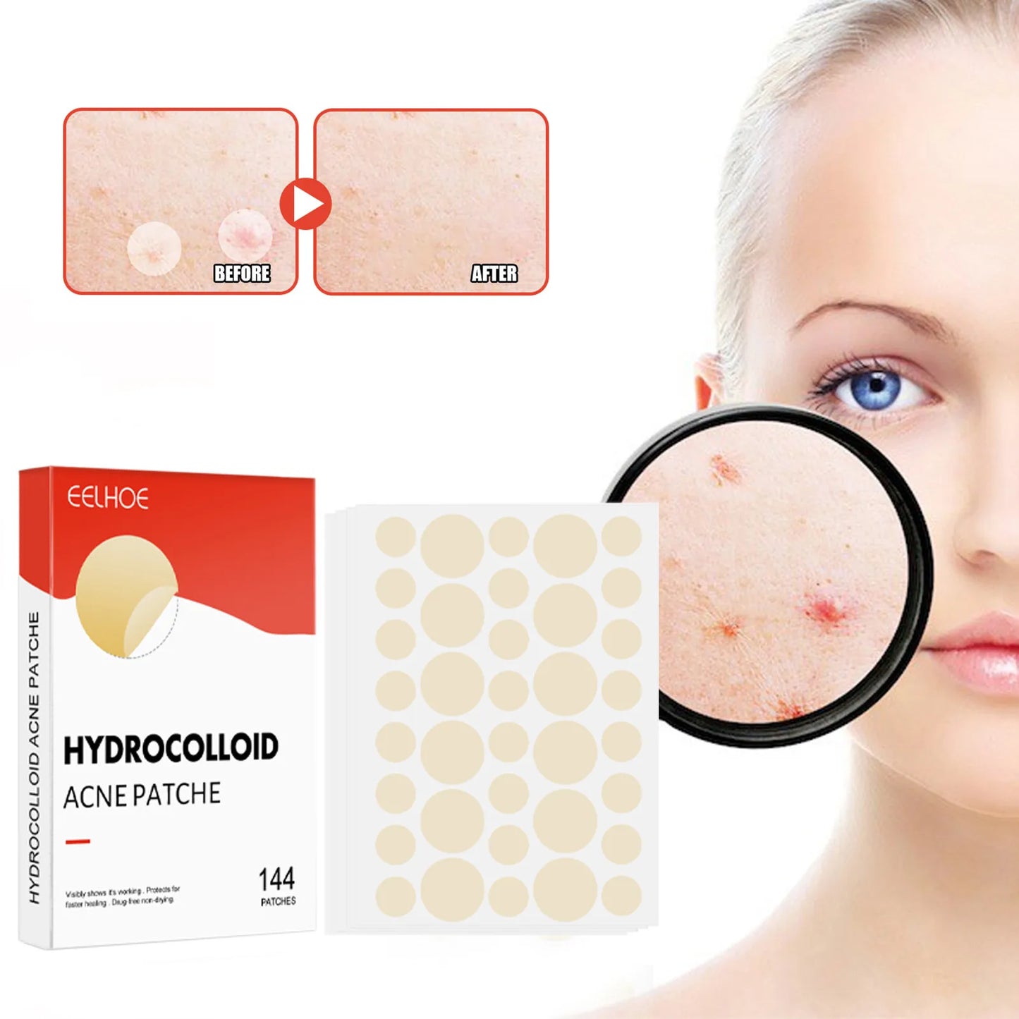 Hydrocolloid Patches